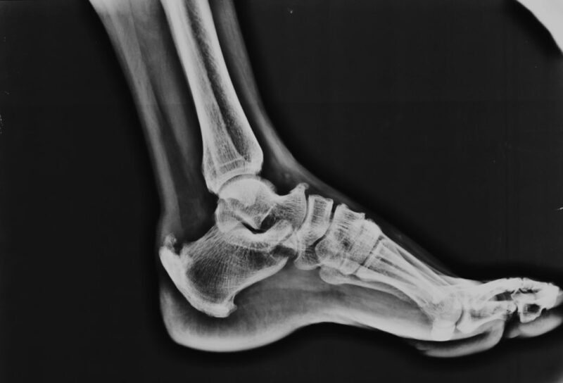 Achilles Tendonitis Diagnosing